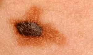 علاج واعد لسرطان الجلد المتقدم