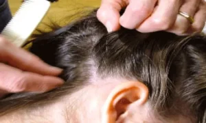 علاج جديد وفعال لقمل الرأس