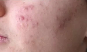 جيل جديد لعلاج ندوب الشباب