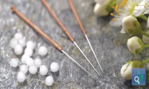 الوخز بالإبر: تعزيز الذاكرة وتقليل التوتر