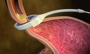 مخاطر جراحة ربط المعدة طويلة الأمد