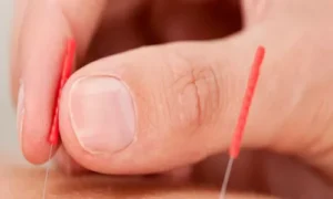 الوخز بالإبر يخفف إعياء مرضى السرطان