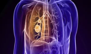 أدوية تقلل وفيات سرطان الرئة: دراسة