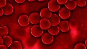 فرط بروتينات الدم الشحمية | Hyperlipoproteinemia