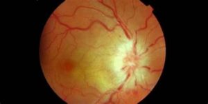 التهاب الحليمة | Papillitis