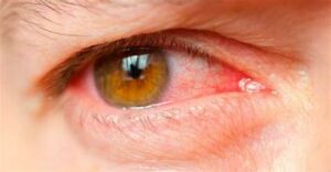 التهاب الجفن والملتحمة | Blepharoconjunctivitis
