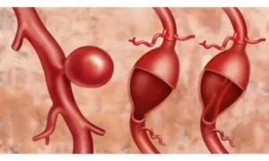 توقع تمزق الأوعية الدموية بعد تمددها