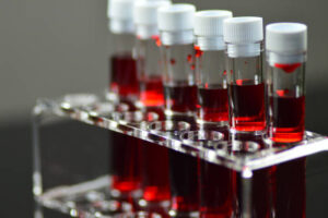 ابيضاض نخاعي حاد | Acute myeloid leukemia
