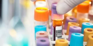 فحص الغلوبولينات البردية | Cryoglobulin Blood Test