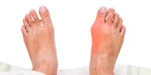 تحليل حمض اليوريك في البول | Uric Acid Urine Test