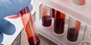 الكالسيوم | Total Calcium Test