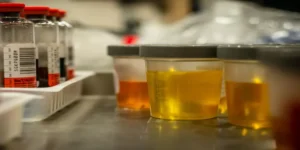 فحص مظهر البول الخارجي | Urine Appearance Test