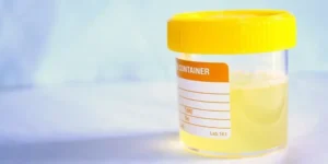 فحص عكورة البول | Urine Turbidity Chart
