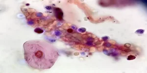 تحليل الاسطوانات البولية | Urinary Casts Test