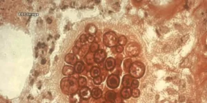 فحص مسحة الفطريات للبلغم | Sputum Fungal Smear